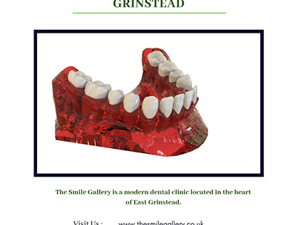 Implants In East Grinstead
