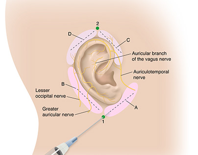Auricular Block of Ear