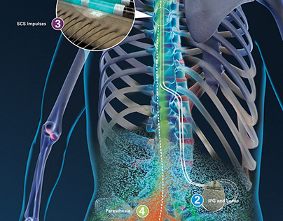 How Does A Spinal Cord Stimulator Work?