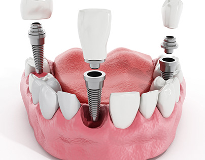 Vì sao trồng răng implant được ưa chuộng