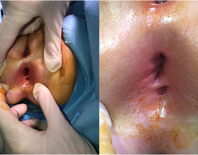 Fistula Painless Surgery