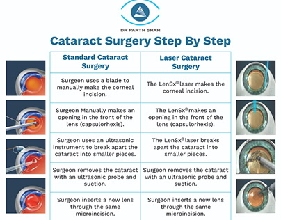 Difference between standard cataract surgery