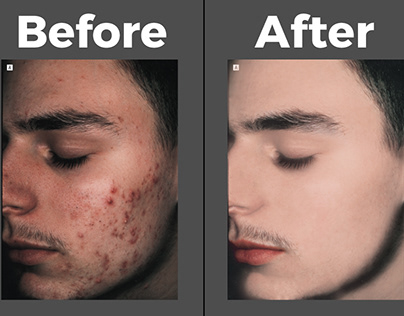 Face Acne Remove