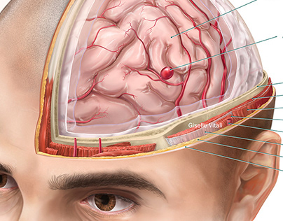 Aprendiendo ilustración médica: Aneurisma Cerebral