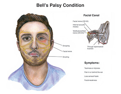 Bell's Palsy Condition