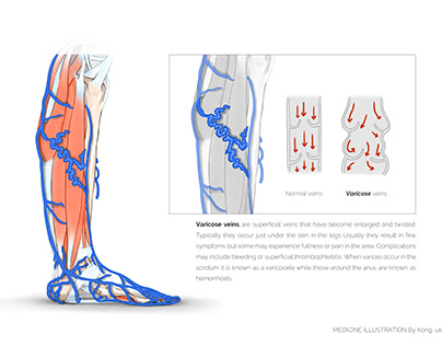 Medical illustration / Varicose veins