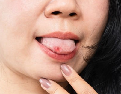 An Overview of Tongue Ulcer Treatment – 2024