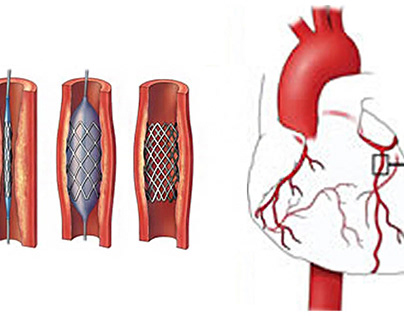 Coronary Angiography Treatment in Shalimar Bagh