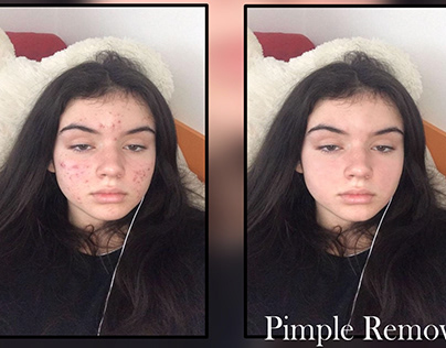 pimple remover