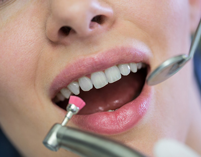 Can Dental Cleanings Help Prevent Tooth Sensitivity?