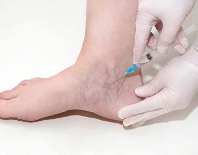 Why Varicose Vein Treatment is Performed?
