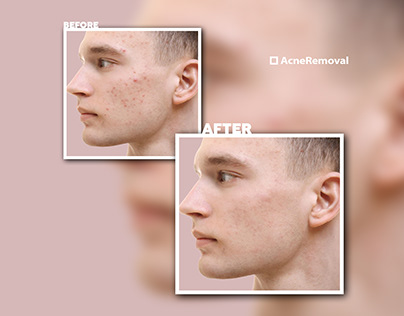 Acne removal
