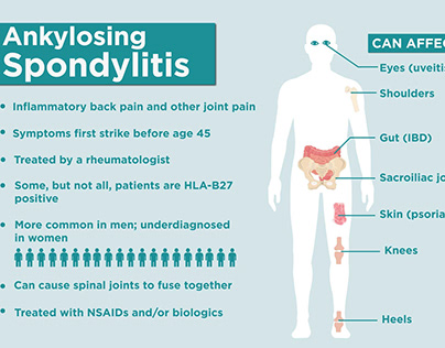 Ankylosing Spondylitis: Navigating the Landscape