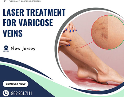 Laser Treatment For Varicose Veins NJ