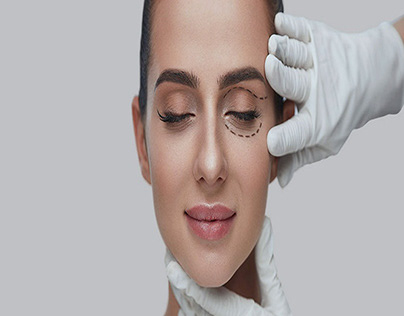 Blepharoplasty ( Eyelid Surgery ) in Delhi