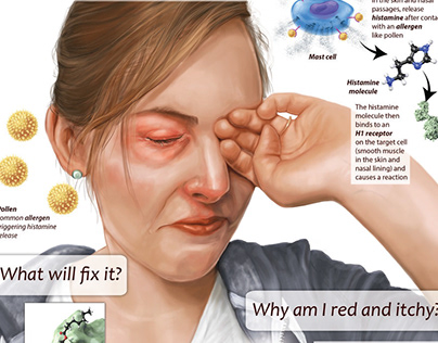 Allergies and histamine