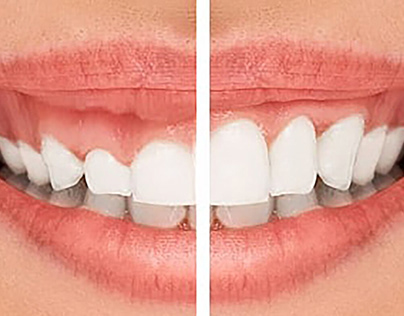 Transform Your Smile in Just One Day
