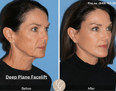 Rediscover Youthful Radiance with Deep Plane Facelift