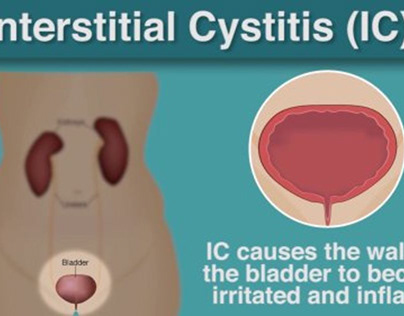 Manage Interstitial Cystitis