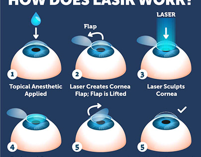 Best LASIK Eye Surgery in Hyderabad