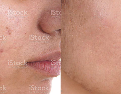 water mark & pimple remove