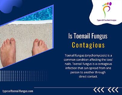 Is Toenail Fungus Contagious