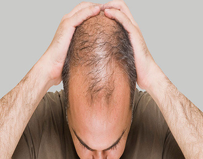 Techniques Of Hair Transplant | Hair Loss Treatment