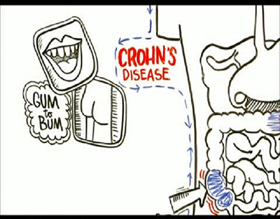 Treat Crohn's Disease with Experienced Colitis Doctor