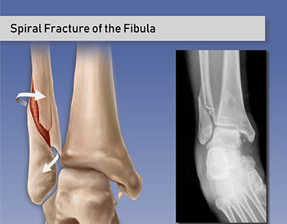 Spiral Fracture of the Fibula