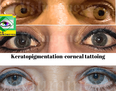 keratopigmentation-laser eye color change comparison