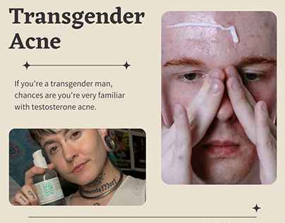 Treating Acne in Transgender Persons