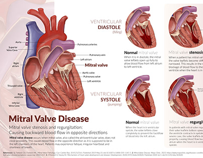 Medical illustration: Mitral valve disease