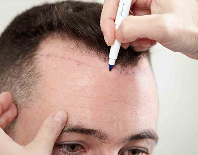 Hair Restoration – Procedure, Cost & Effectiveness
