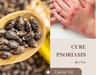 Castor oil provides relief from psoriasis flare-ups