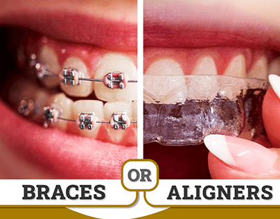 Visible or Invisible | Braces or Clear Aligners