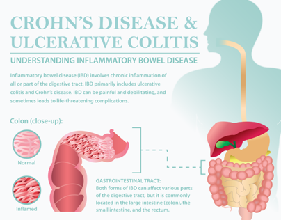 Crohn's & Colitis Infographic