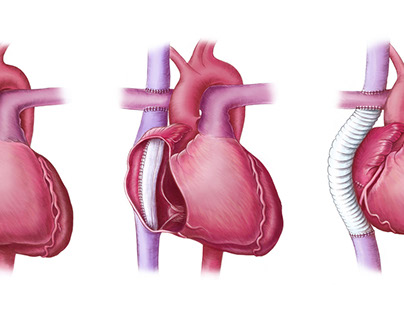 Fontan Procedure published in EMJ Cardiology