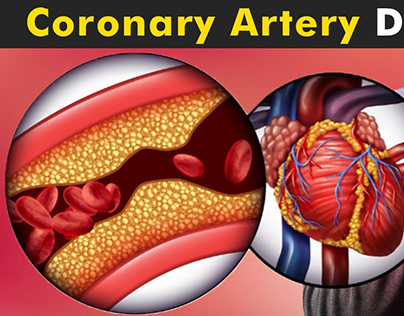 Coronary Artery Disease Treatment in Shalimar Bagh
