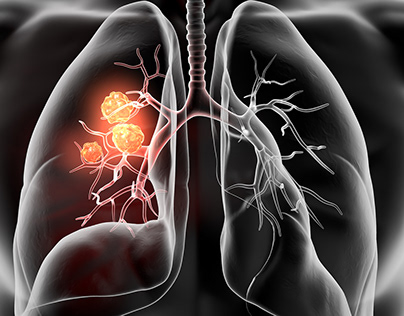 dovresti essere consapevole del cancro al polmone