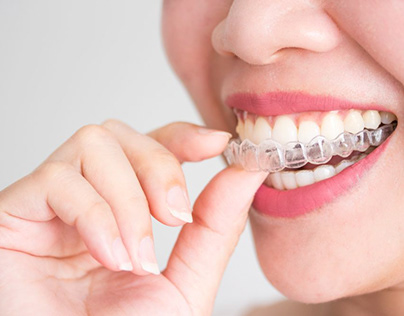 Niềng răng mất bao lâu để có hàm răng đều đẹp?