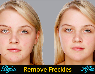 Freckles Remove on Face