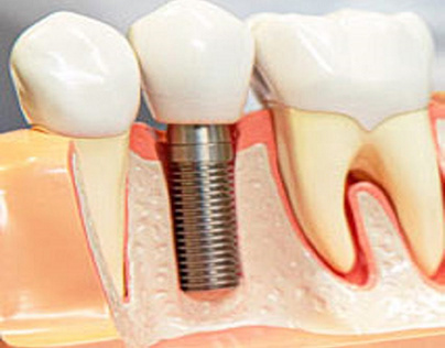Dental implant cost in Delhi