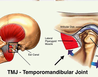 Understanding TMJ Dysfunction