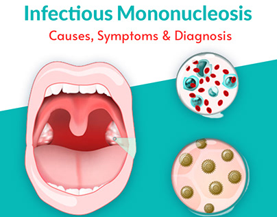 Know more about Mononucleosis