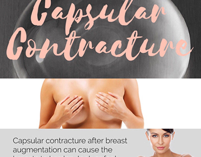 Photos of Capsular Contracture