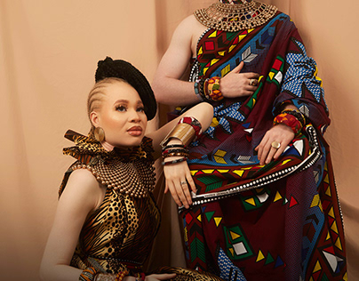 Albinism In Nigeria