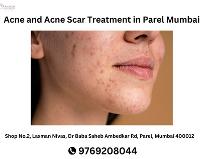Acne and Acne Scar Treatment in Parel Mumbai