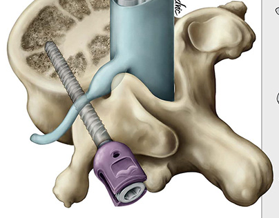 Transpedicular screw fixation