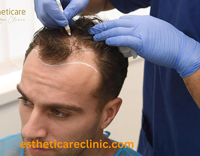 FUE HAIR TRANSPLANT IN ISLAMABAD