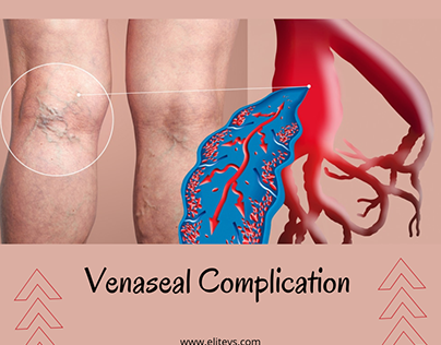 Venaseal Complications